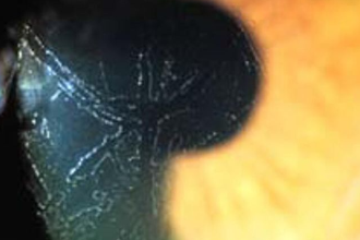 隐形眼镜常见沉淀物—蛋白质沉淀